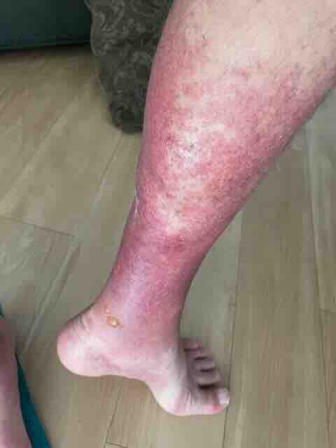 burns 1